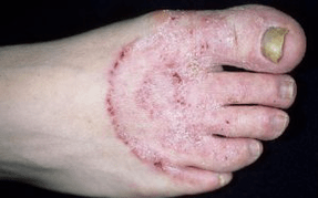 Οι λόγοι για την εμφάνιση του μύκητα στα πόδια