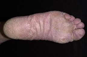 Σημεία και συμπτώματα μύκητας στα πόδια