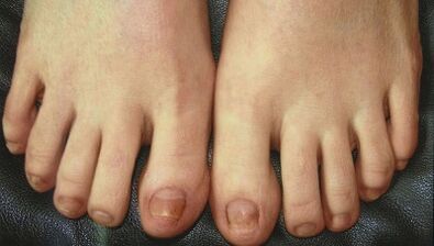 Στάδια ανάπτυξης μύκων νυχιών