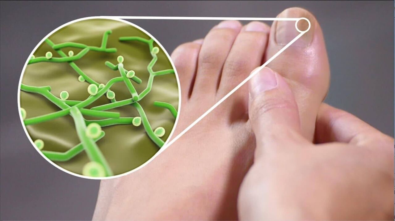 παθογόνα του μύκητα των νυχιών των ποδιών