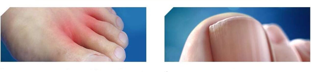 αρχικό στάδιο του μύκητα των ποδιών